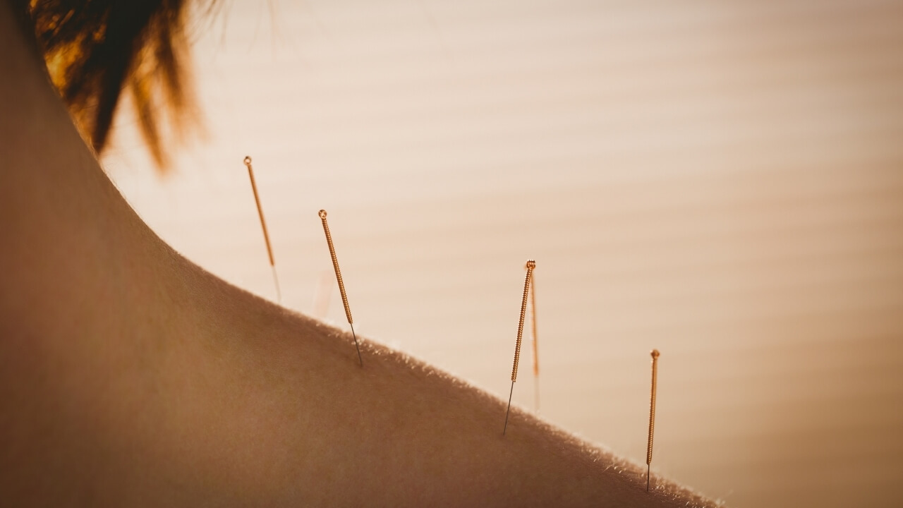 Acupuntura O que é e Como Funciona Essa Terapia Alternativa
